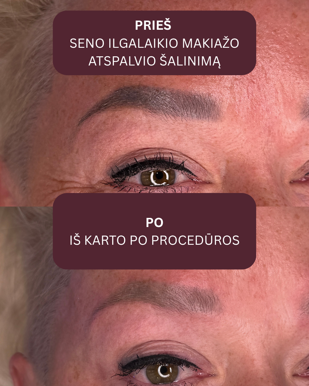 Lazerinis ilgalaikio makiažo šalinimas — prieš ir po